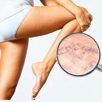 Hemorrhoids and varicose veins