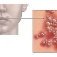 Eczema, herpes, psoriasis and other skin problems