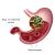 Effects of Helicobacter infection